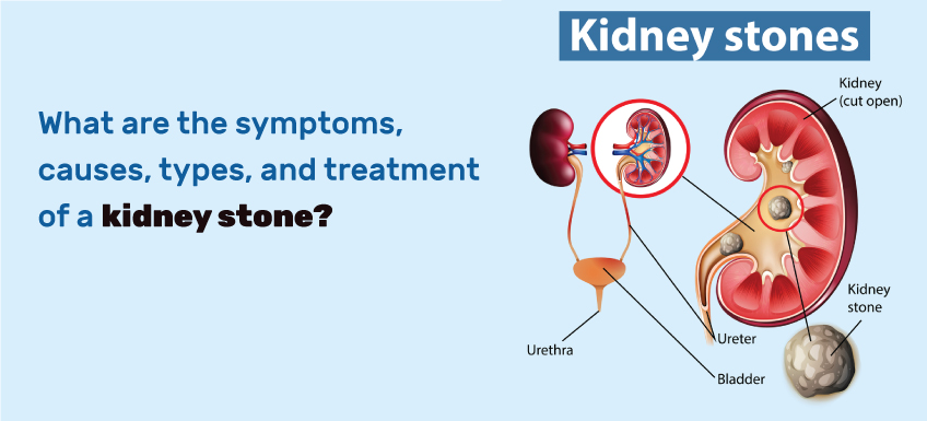 KIDNEY STONE SURGERY