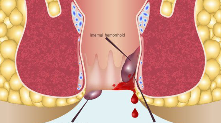 Piles Hospital in Ahmedabad | Painless Laser Piles Surgery