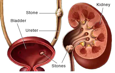 Ureteral Stone Treatment in Ahmedabad