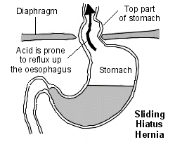 acidity-surgery