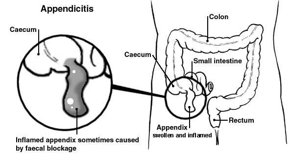 appendix surgery in Ahmedabad