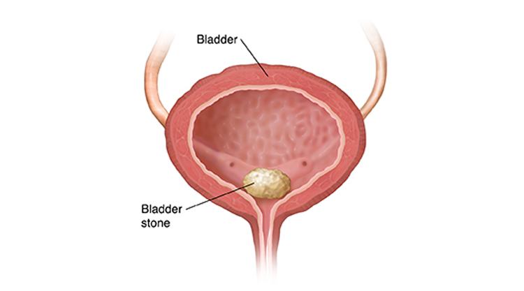 Bladder Stones