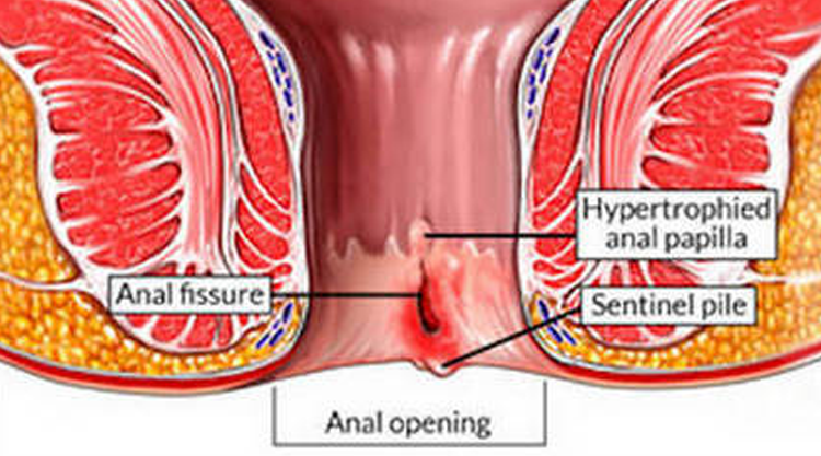 Laser Treatment for Fistula in Ahmedabad | Laser Fistula Surgery