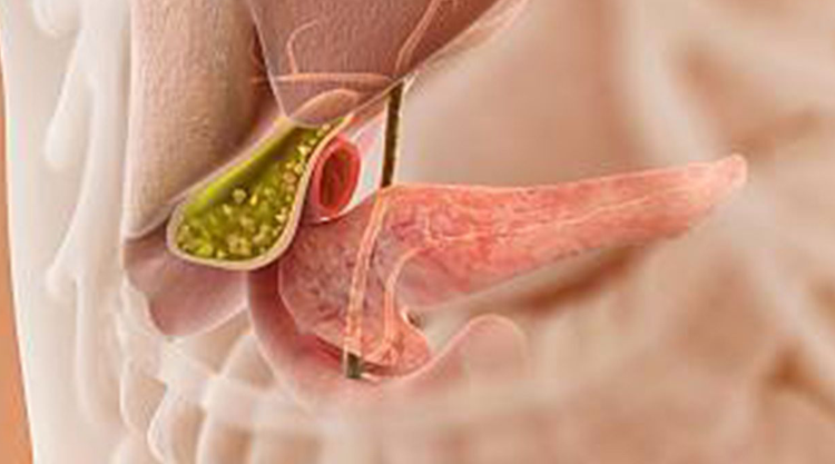 Gallbladder stone surgery in Ahmedabad