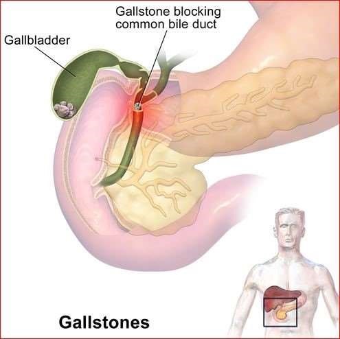 best hospital for gallbladder stone surgery in Ahmedabad