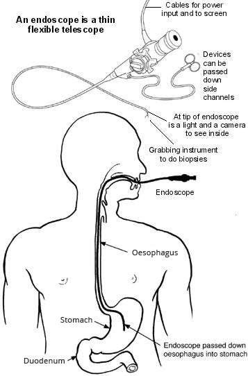 gastroscopy