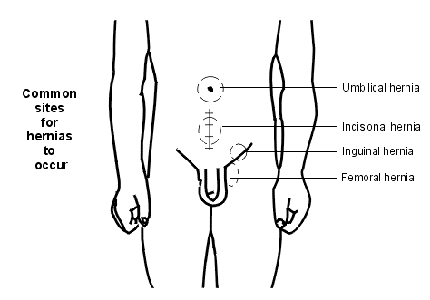 hernia doctor in ahmedabad