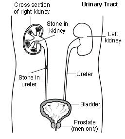 Ureteral Stone