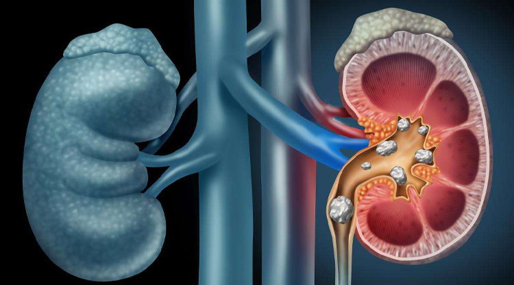 Kidney Stone Doctor in Ahmedabad