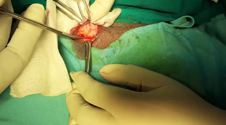 Perianal Abscess Drainage